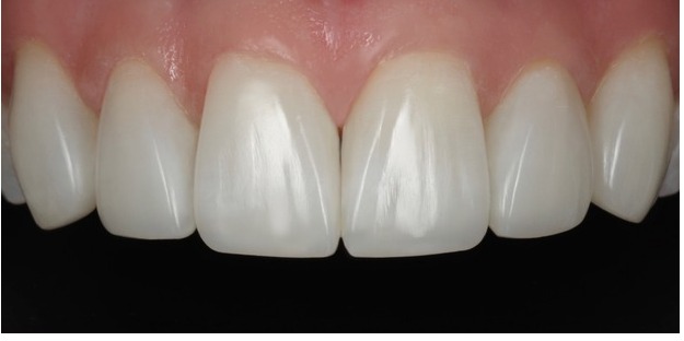 Case 1, anterior detail, after composite bonding treatment by Dr Pete