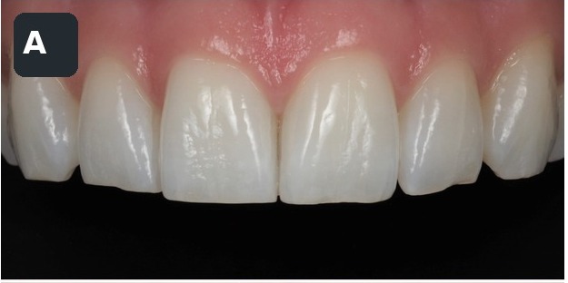 Case 1, anterior detail, before composite bonding treatment by Dr Pete