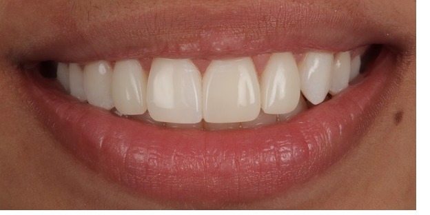 Case 3, full smile, after composite bonding treatment by Dr Pete