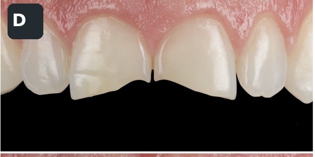Case 4, anterior close-up, before composite bonding treatment by Dr Pete